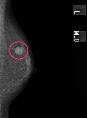低濃度マンモグラフィー乳がん症例