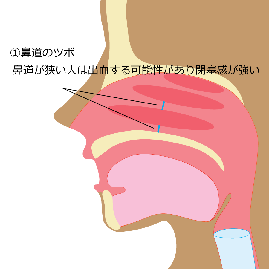 胃カメラ,内視鏡,鼻から,麻酔,鎮静剤,神戸市北区,病院鼻からの胃カメラのメリット