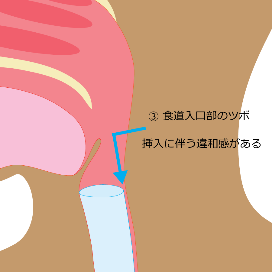 胃カメラ,内視鏡,鼻から,麻酔,鎮静剤,神戸市北区,病院オエッとならない胃カメラ