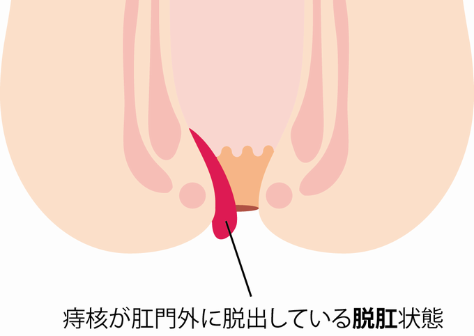 いぼ痔の治療は神戸北区のこば消化器乳腺クリニックへ