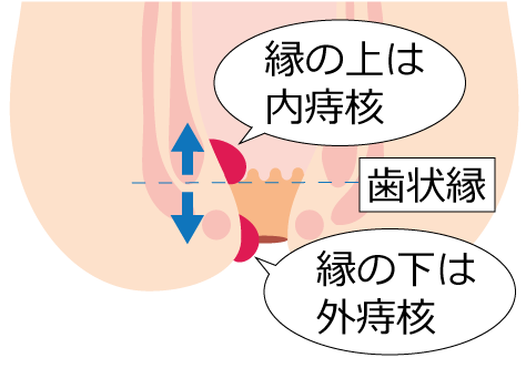 いぼ痔の治療は神戸北区のこば消化器乳腺クリニックへ