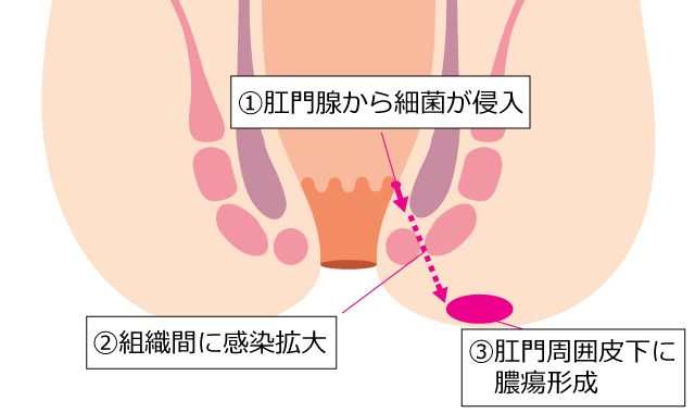 肛門周囲膿瘍の図説