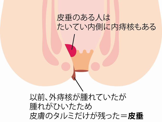 いぼ痔の治療は神戸北区のこば消化器乳腺クリニックへ